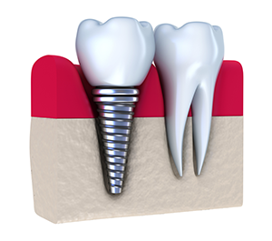dental implants Payson UT